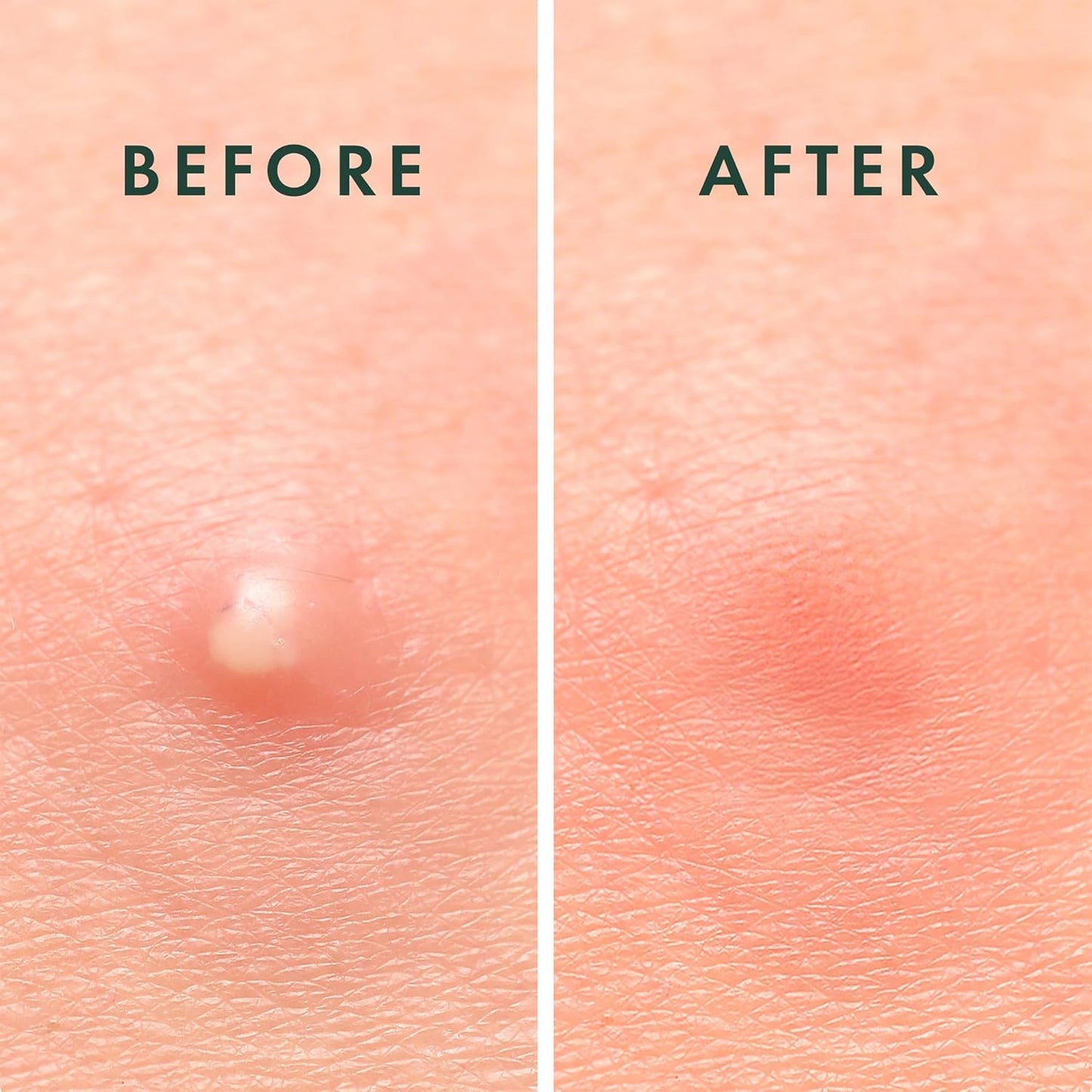 Rael Pimple Patches, Miracle Invisible Spot Cover - Hydrocolloid Acne Patch, Treatment for Breakouts, Absorbs Zits & Blemish, Korean Skin Care, 2 Sizes (72 Count)