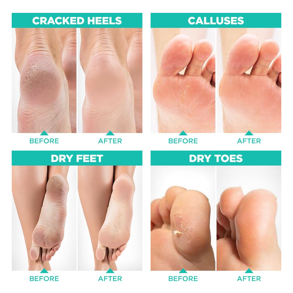 Lavinso Foot Peel Mask for Dry Cracked Feet – 2 Pack Peeling Mask Removes Dead Skin and Calluses - Exfoliating for Soft Baby Feet, Original Scent