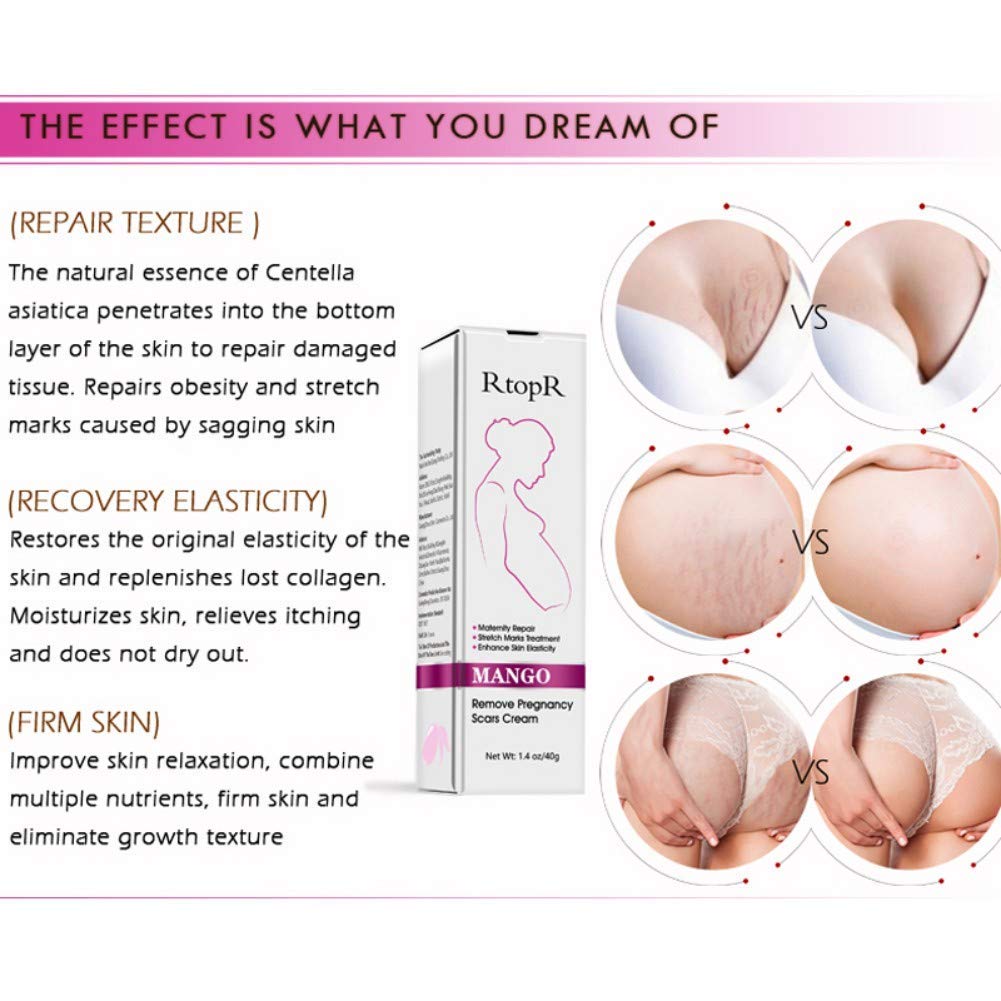 Mango Stretch Marks and Scar Cream, Stretch Marks and Scar Removal Cream for Pregnancy, Stretch Marks Scar Belly Creams for Wrinkles, Obesity Fat Stretch Mark Moisturizing, Remove Marks (40g)