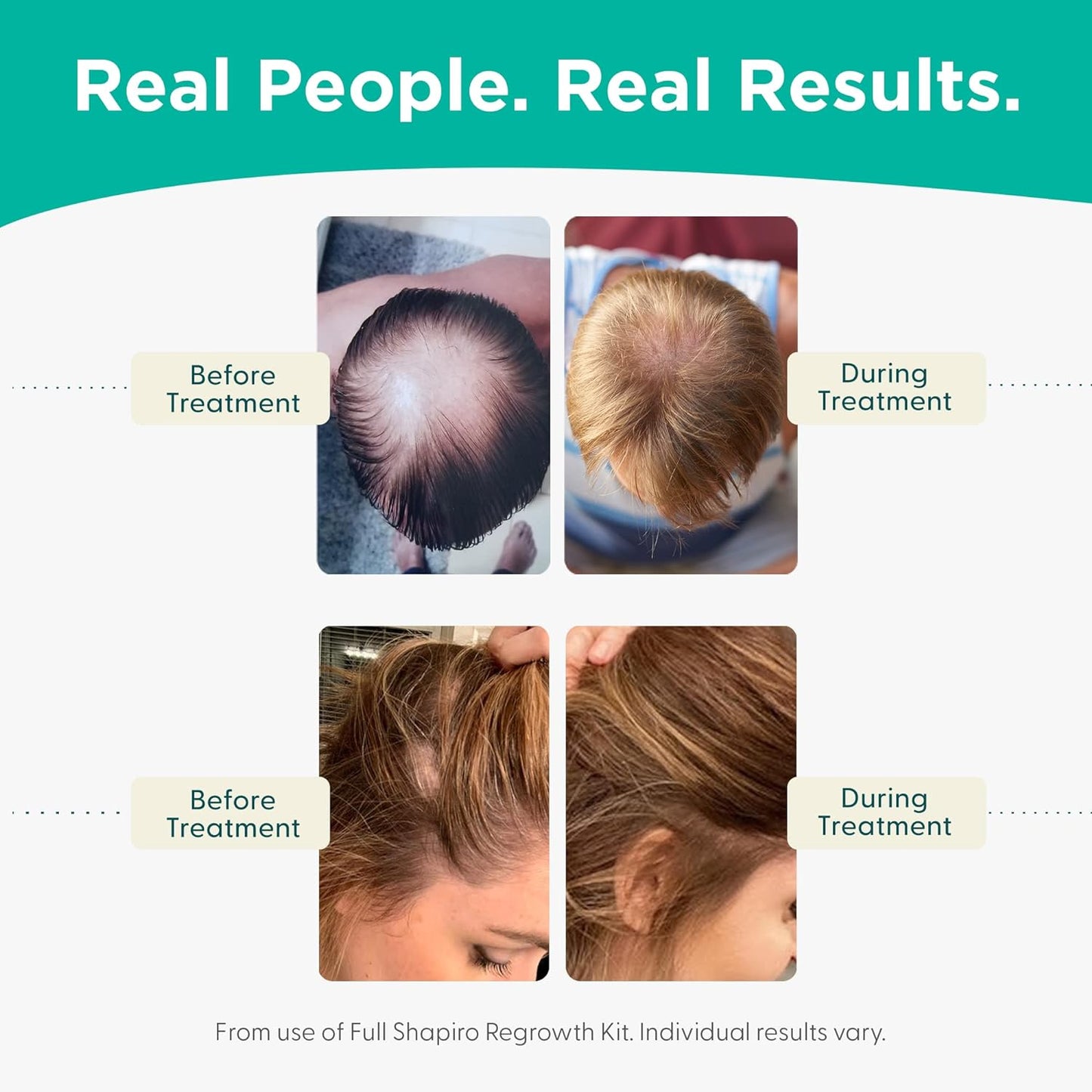 Shapiro MD Hair Growth Experts Leave-In Daily Foam, DHT Fighting Vegan Formula for Thinning Hair Developed by Dermatologists, Experience Healthier, Fuller & Thicker Looking Hair, 1 Month Supply